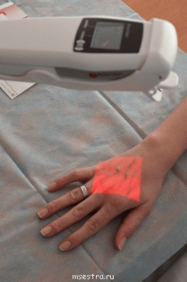 Какие бывают приборы для визуализации вен? - 2.gif